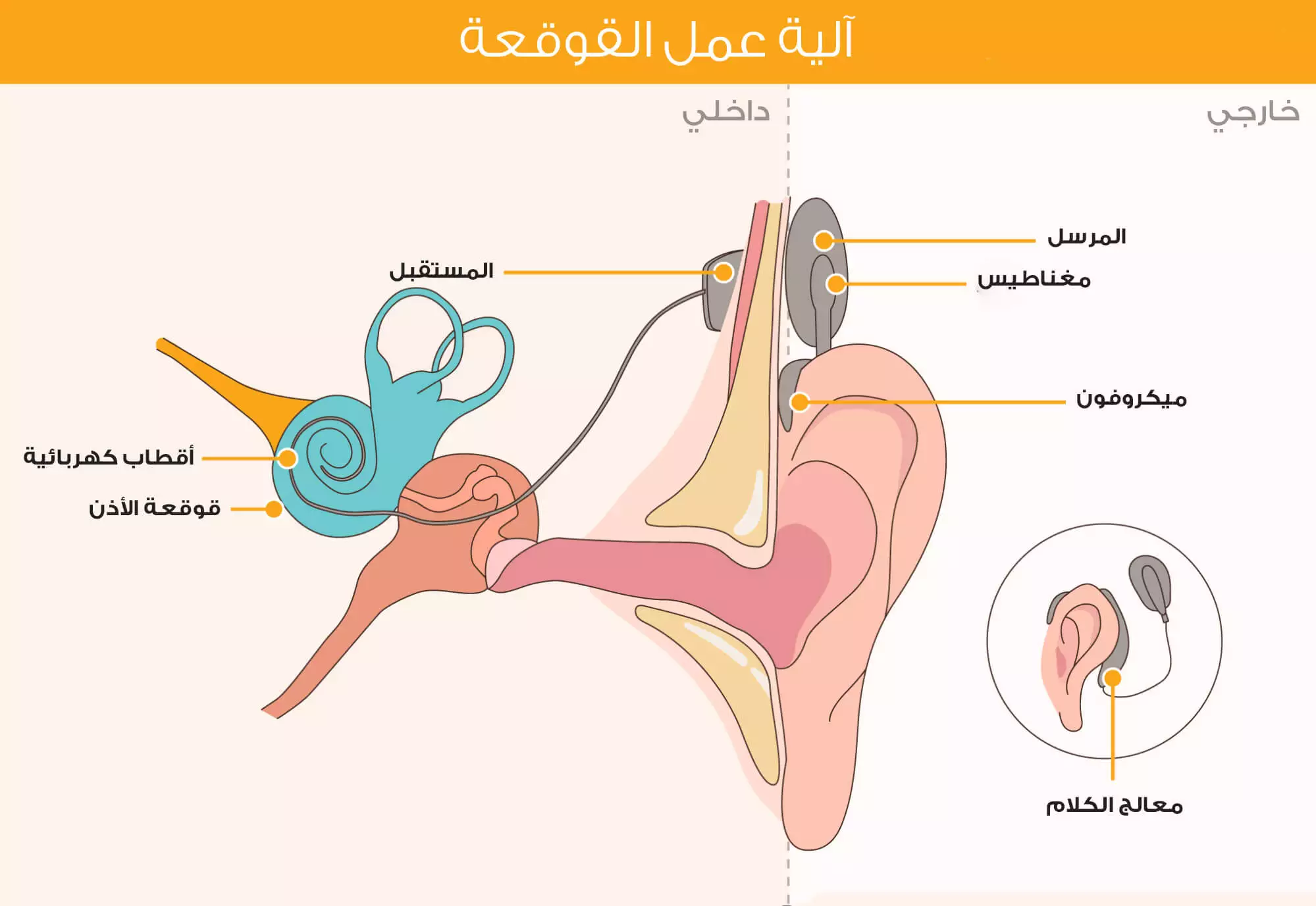 صورة توضح مكونات عملية زراعة القوقعة الالكترونية