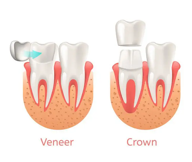 من أنواع تلبيس الأسنان التيجان Crowns والفينير Veneer