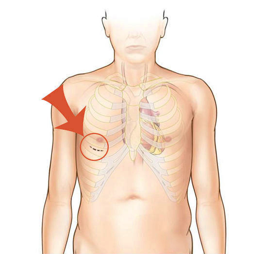 شكل وموقع الشق الجراحي في عملية تغيير الصمام التاجي للقلب