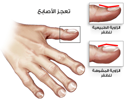 تعجر الأصابع عند مرضى سرطان الرئة