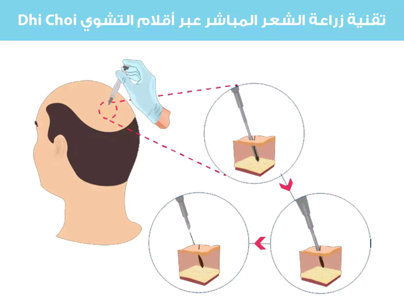 تقنية زراعة الشعر المباشر عبى أقلام التشوي Dhi Choi