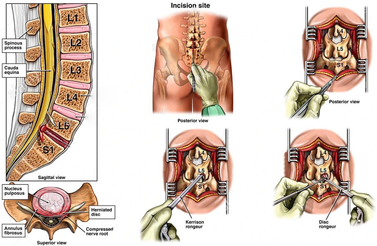 صورة لجراحة الديسك عبر المجهر