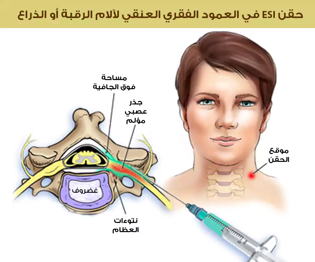 حقن الستيروئد في العمود الفقري العنقي في تركيا لعلاج ألم الرقبة والذراع