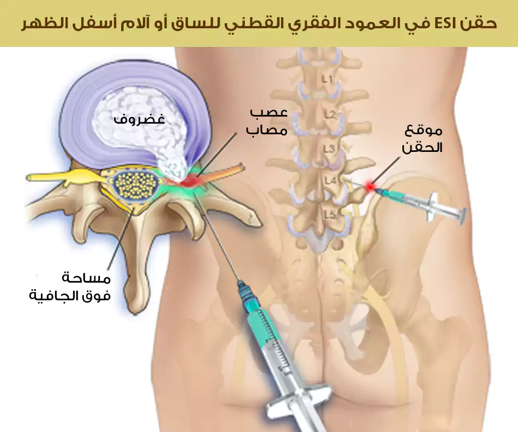 حقن الستيرئد في العمود الفقري القطني في تركيا لتدبير ألم الساق وأسفل الظهر