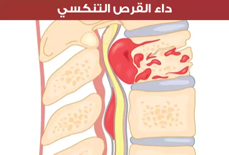 نلاحظ في هذه الصورة داء القرص التنكسي حيثُ يحصل انهيار بمساحة القرص ونمو نتوءات العظم