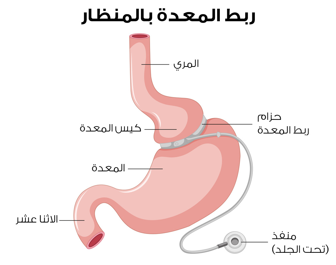 Laparoscopic Gastric Banding