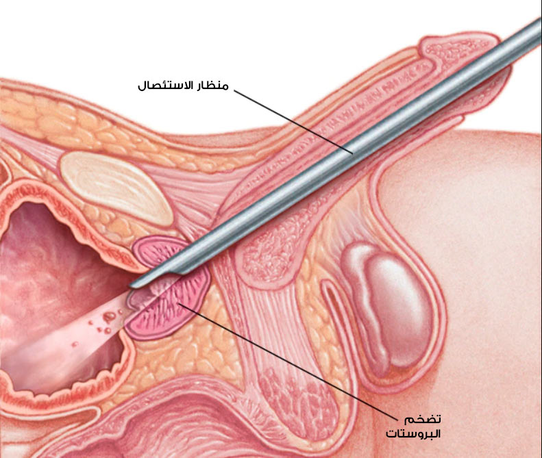 رسم توضيحي لعملية استئصال البروستاتا عبر الإحليل Turp 