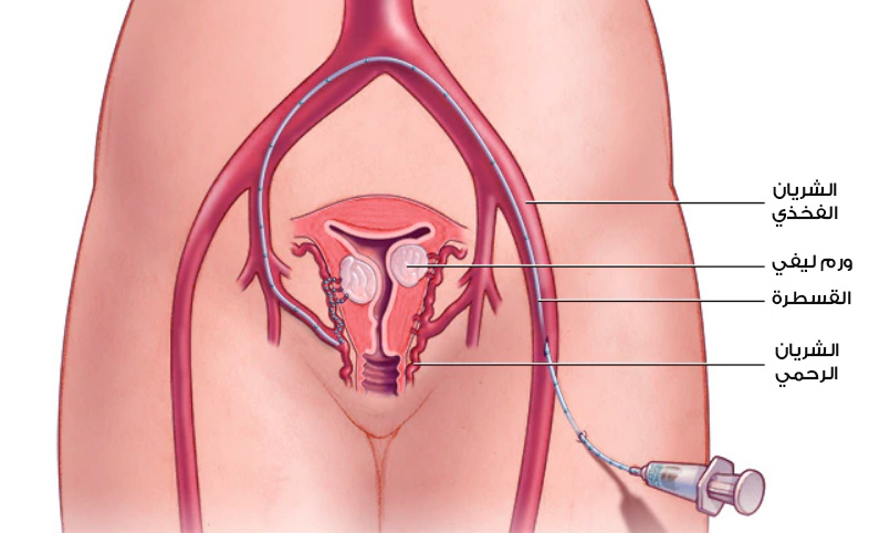 علاج أورام الرحم الليفية بالقثطرة