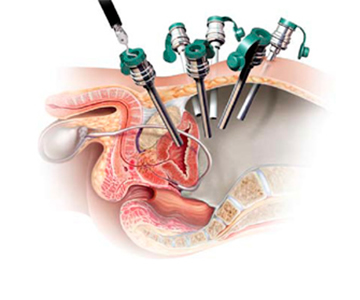 صورة توضح عملية استئصال البروستات بواسطة الروبوت