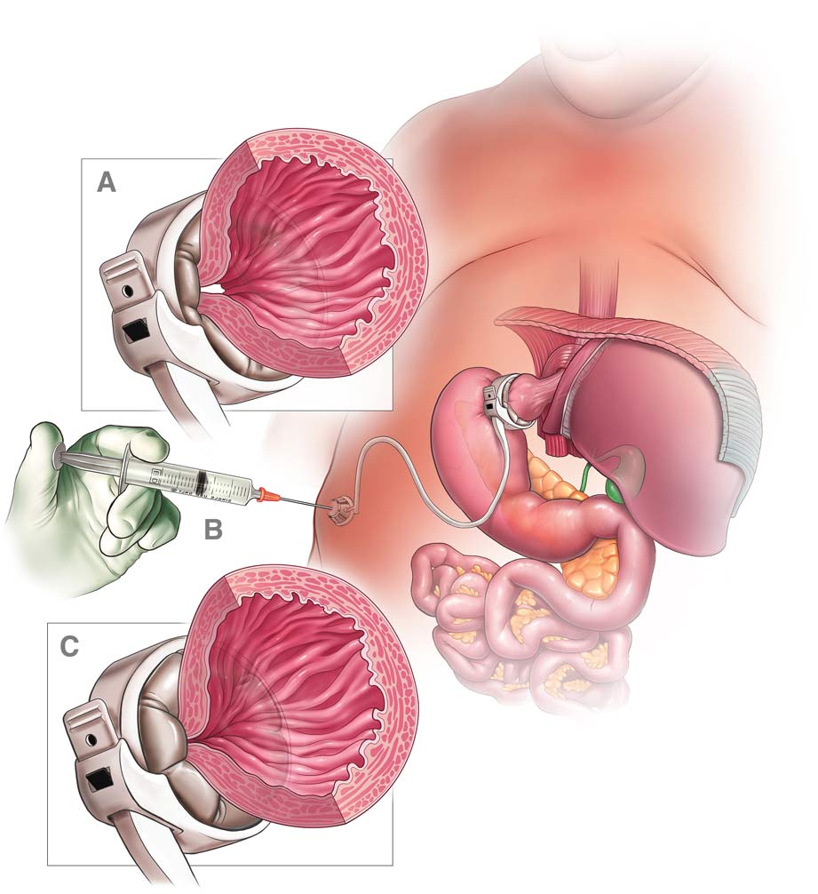 The Mechanism Of Gastric Banding And How The Doctor Injects Saline To Tighten The Band Around The Stomach