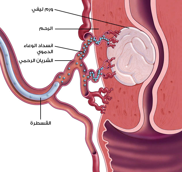 صورة تبين تخثير وسد الشريان المغذي للورم الليفي الرحمي بالقثطرة