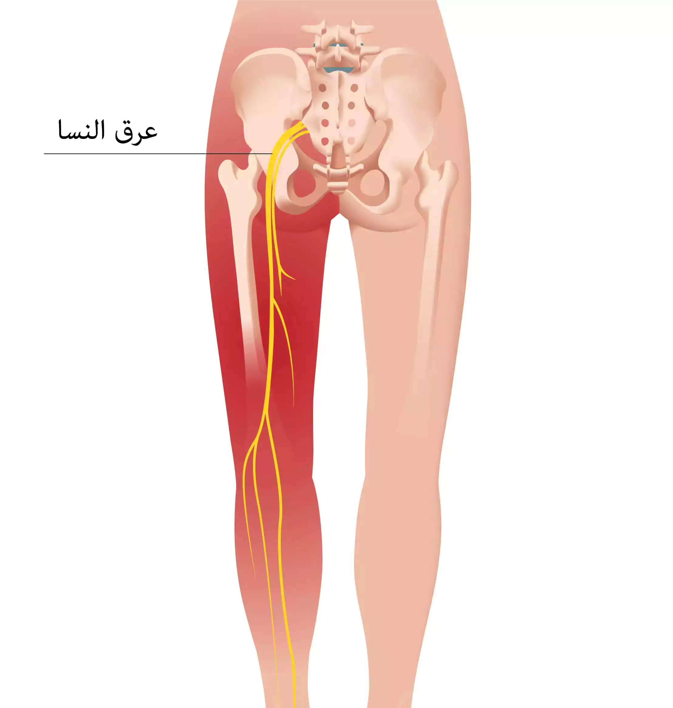 امتداد ألم عرق النسا والذي يمتد على مسار العصب الوركي