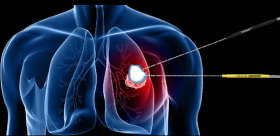 علاج سرطان الرئة بواسطة التجميد