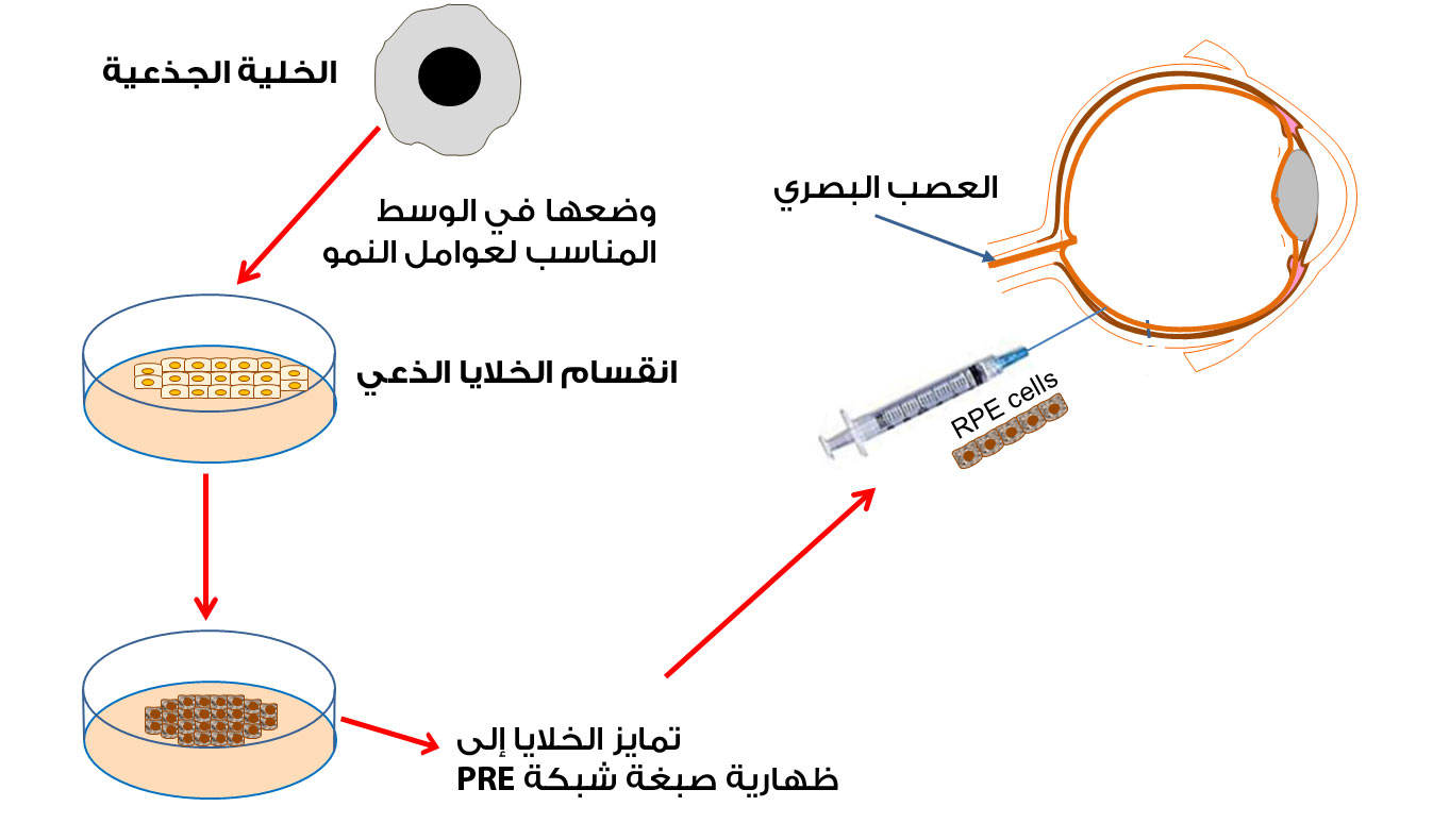 علاج العمى الوراثي بالخلايا الجذعية