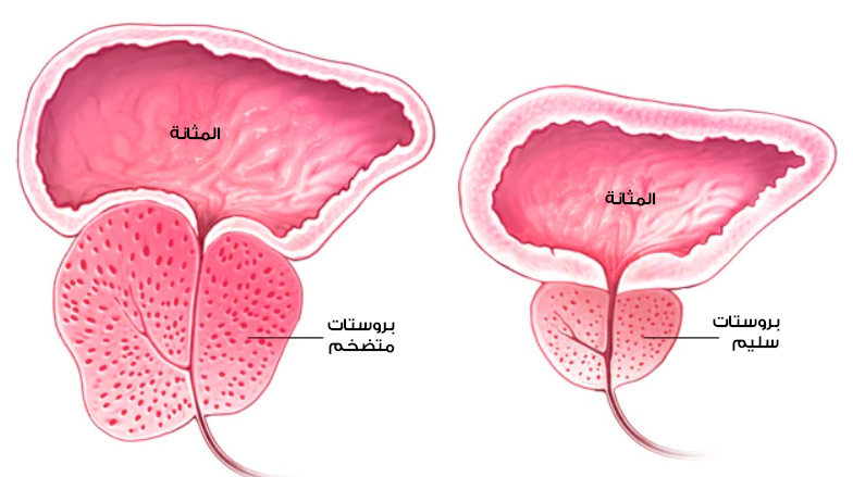 الفرق بين البروستاتا السليمة والبروستاتا المتضخمة