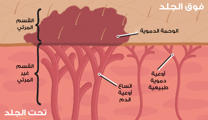 صورة تبين الوحمة الدموية ومكوناتها تحت الجلد وفوق الجلد