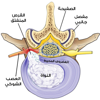 غضروف فقري منزلق (ديسك) قبل عملية الديسك المجهرية