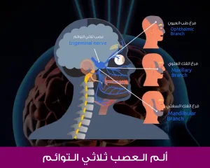 ألم العصب ثلاثي التوائم