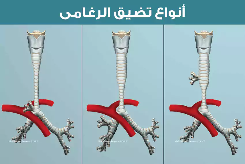 الأنواع التي تتطلب في علاجها جراحة الرغامى (القصبة الهوائية)