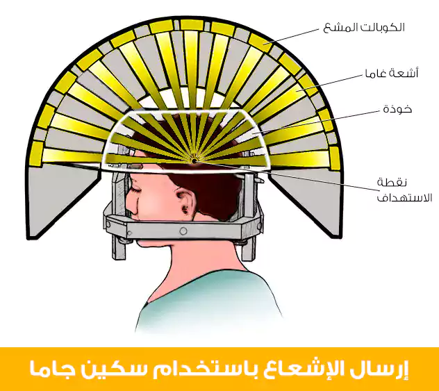 إرسال الإشعاع باستخدام سكين جاما