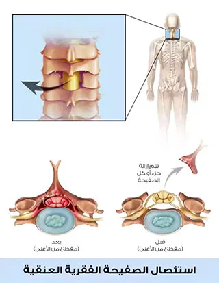 استئصال قسم من الصفيحة الفقرية وهي من الطرق الجراحية لتدبير تضيق العمود الفقري في تركيا