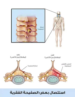 بضع الثقبة الفقرية وهي إحدى أنواع جراحة تضيق العمود الفقري في تركيا