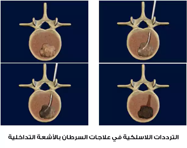 علاج السرطان عبر استخدام الترددات اللاسلكية في تركيا، تُمكن هذه الطريقة من حرق النسيج الورمي وخاصةً في بعض السرطانات كسرطان الكبد وسرطان الرئة بالإضافة إلى النقائل العظمية