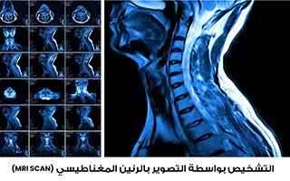 تشخيص تضيق العمود الفقري بواسطة التصوير بالرنين المغناطيسي