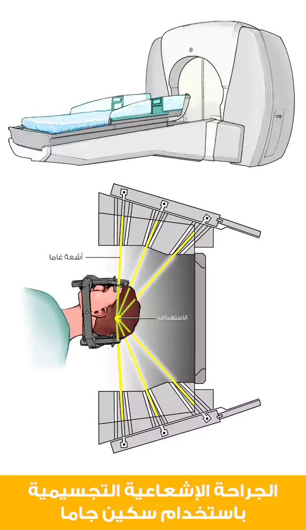 الجراحة الإشعاعية التجسيمية باستخدام سكين جاما