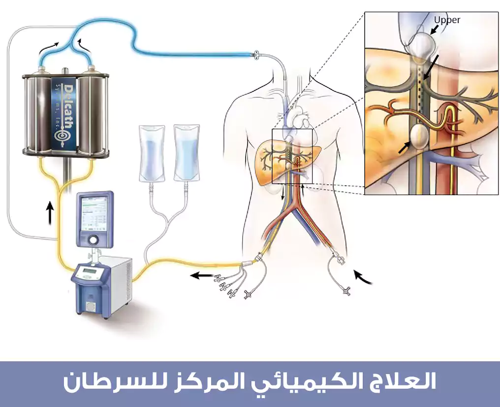 التشبع الكيميائي المستخدم لعلاج السرطان في تركيا