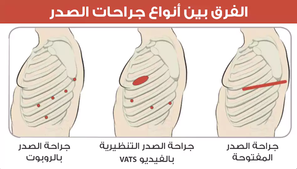 الفرق بين أنواع جراحات الصدر