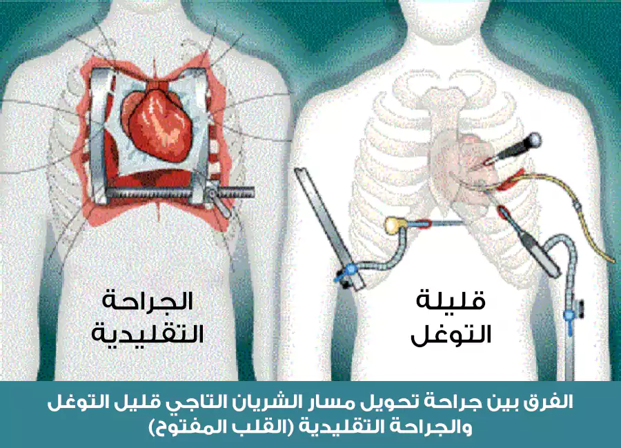 الفرق بين جراحة تحويل مسار الشريان التاجي قليل التوغل