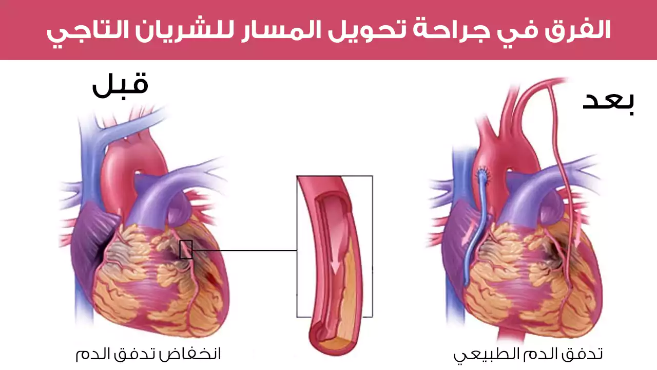 الفرق في جراحة تحويل المسار للشريان التاجي