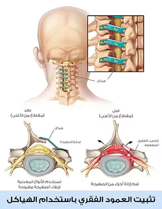 تثبيت العمود الفقري باستخدام الألواح والهياكل