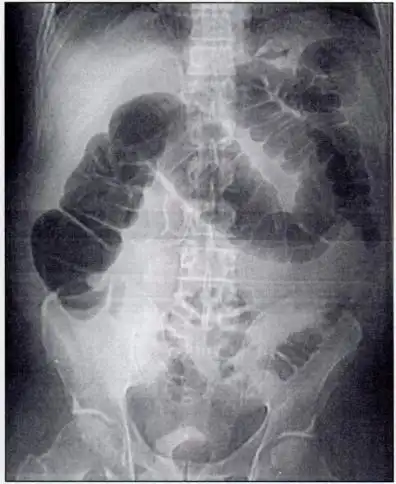 Image Of A Ct Colonography (Virtual Colonoscopy)