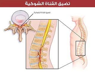 تضيق القناة الشوكية