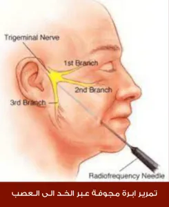 تمرير إبرة مجوفة عبر الخد إلى العصب
