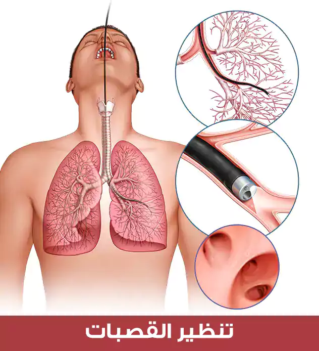 تنظير القصبات والذي يفيد في تشخيص اضطرابات القصبة الهوائية (الرغامى)