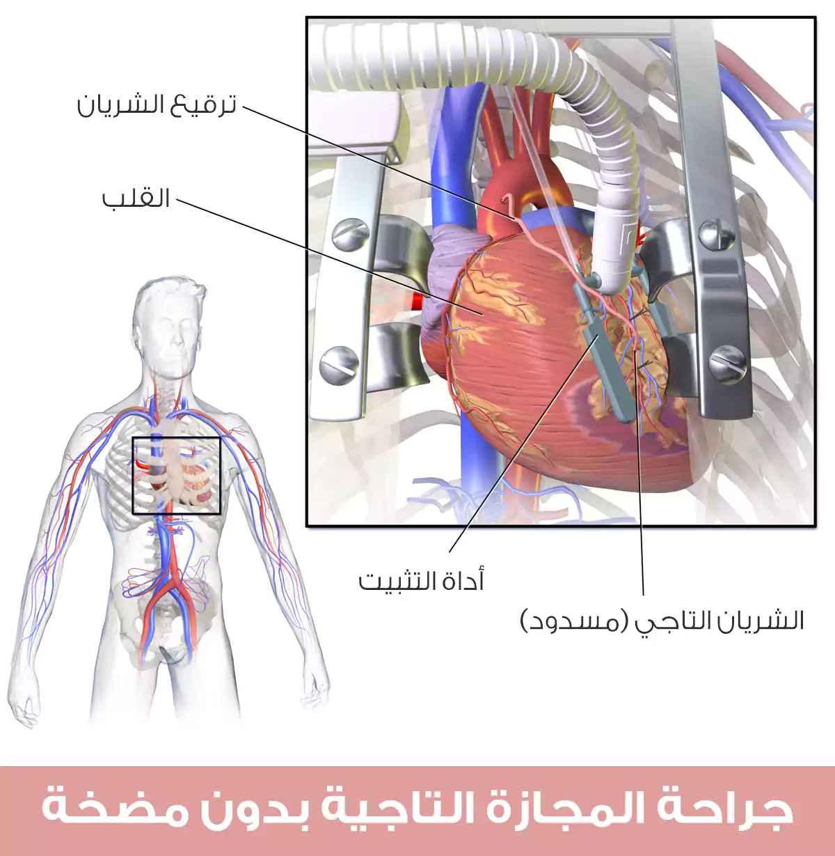 جراحة المجازة التاجية بدون مضخة