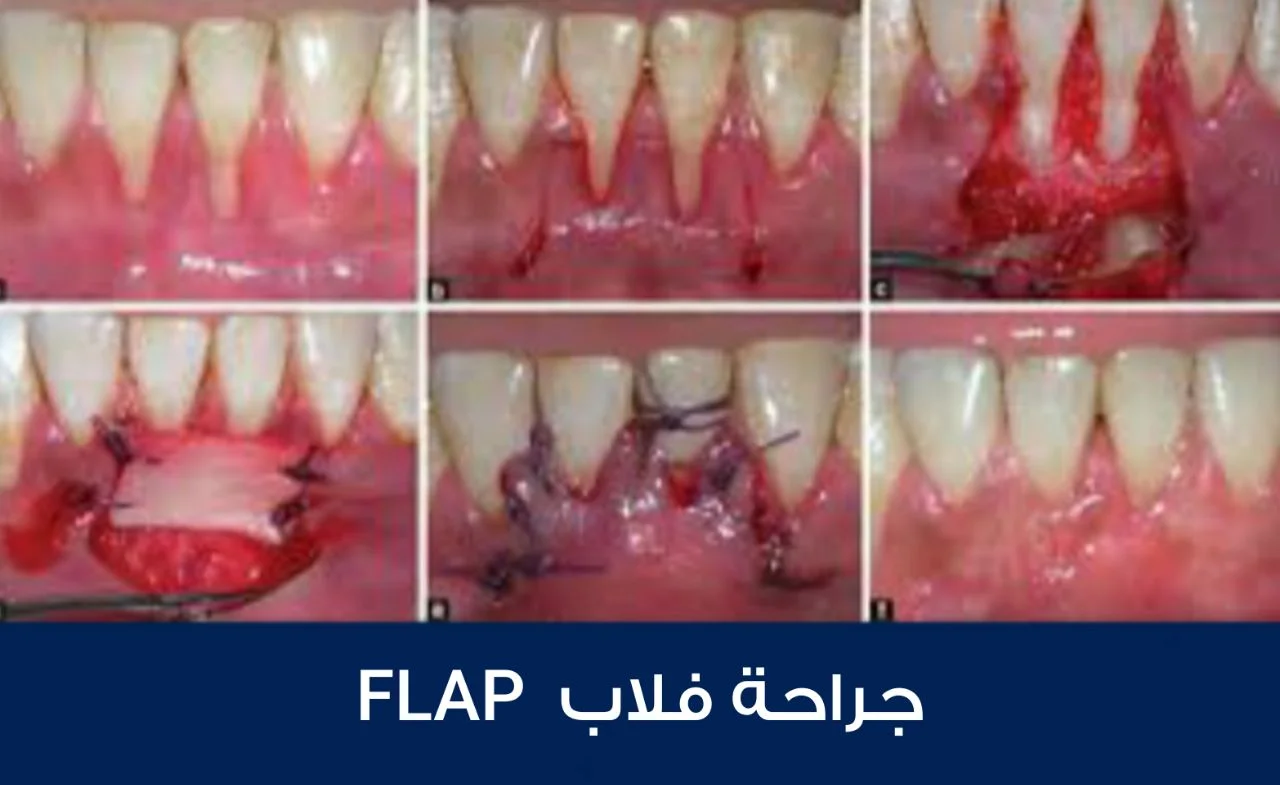 زراعة الأسنان بدون جراحة