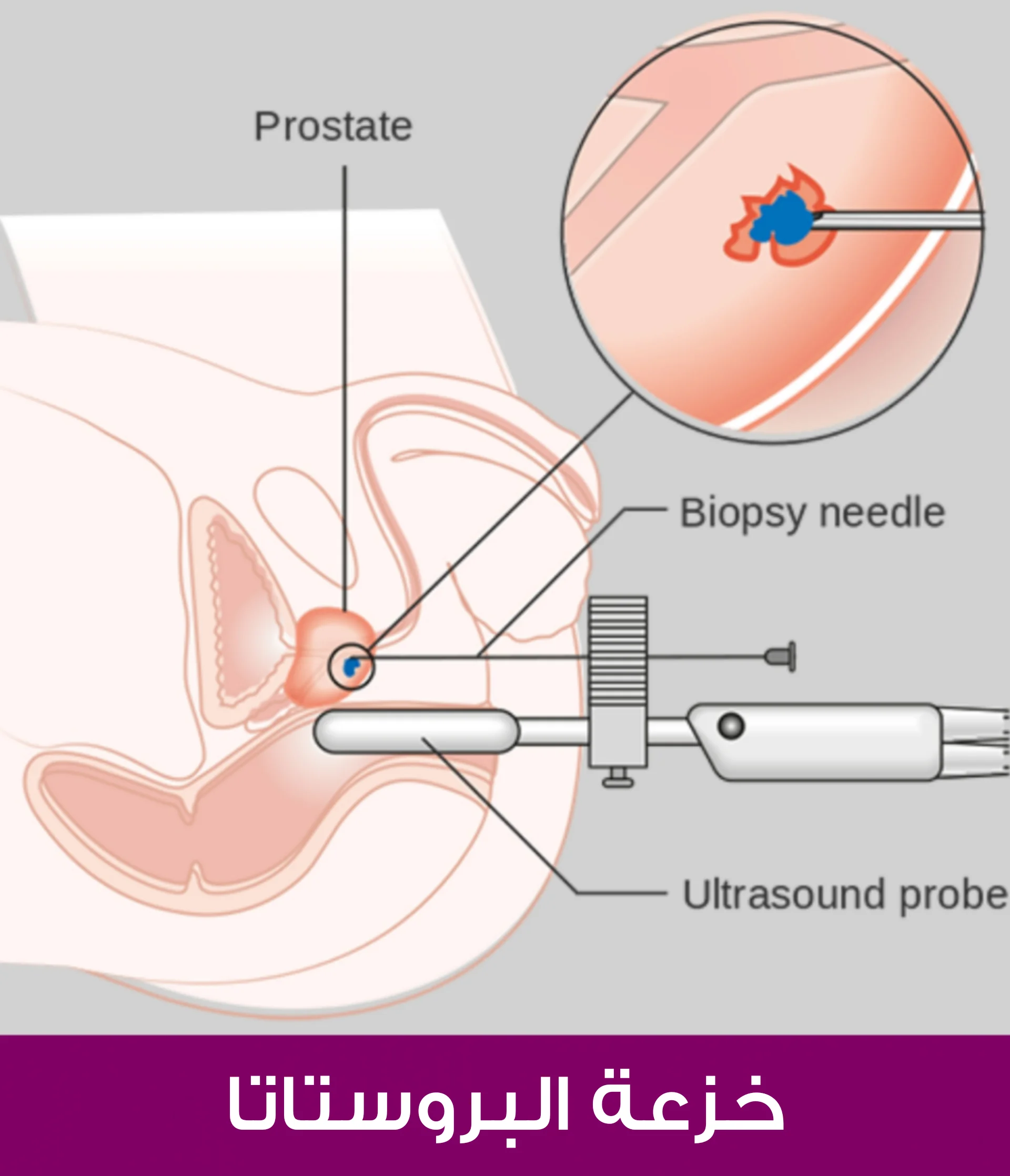 كيفية أخذ خزعة من البروستاتا
