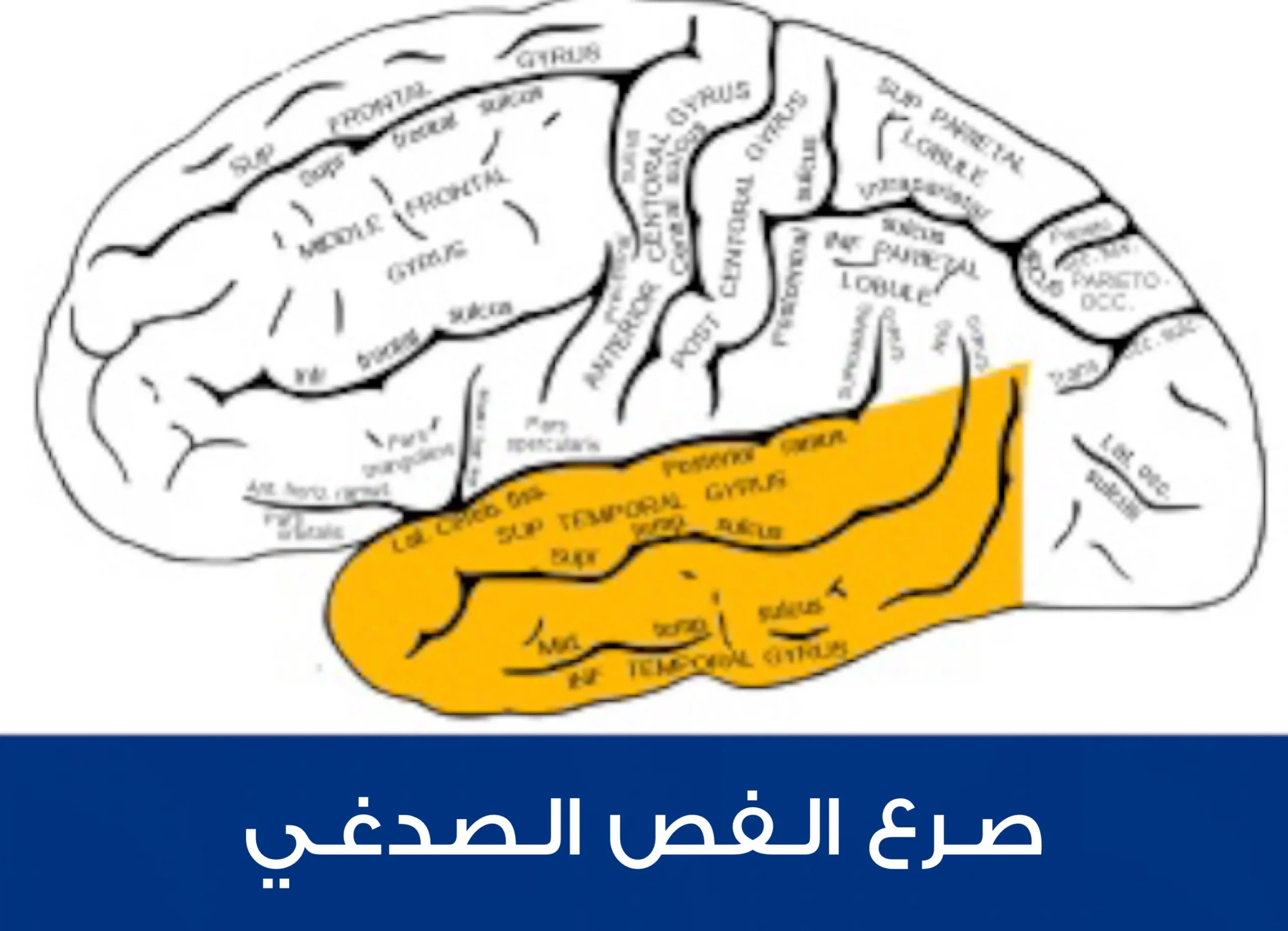 الصرع المتوضع في منطقة الفص الصدغي وهو النمط الأكثر شيوعاً من الصرع