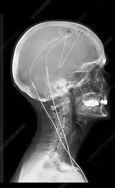صورة شعاعية تظهر جهاز التحفيز العميق الموضوع لعلاج مرض باركنسون