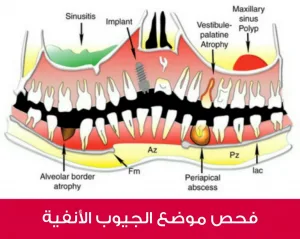 فحص موضع الجيوب الأنفية من أجل زراعة الأسنان في نفس اليوم