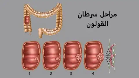 Stages Of Colon Cancer