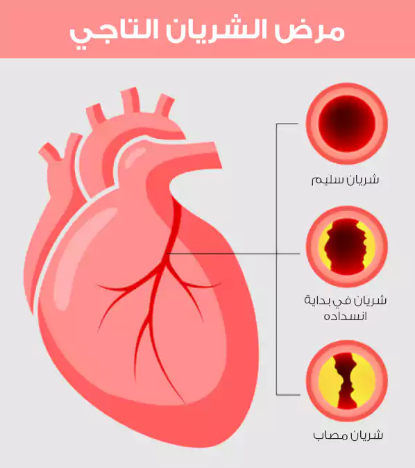 مرض الشريان التاجي