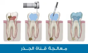 معالجة قناة الجذر