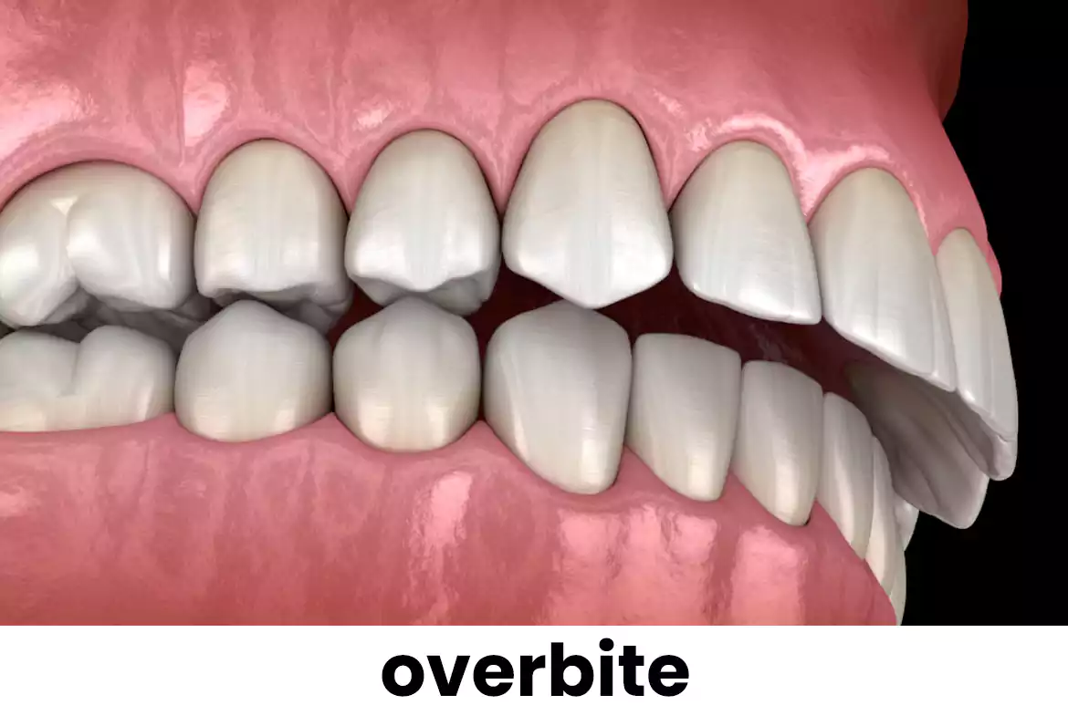 العضة العميقة Overbite