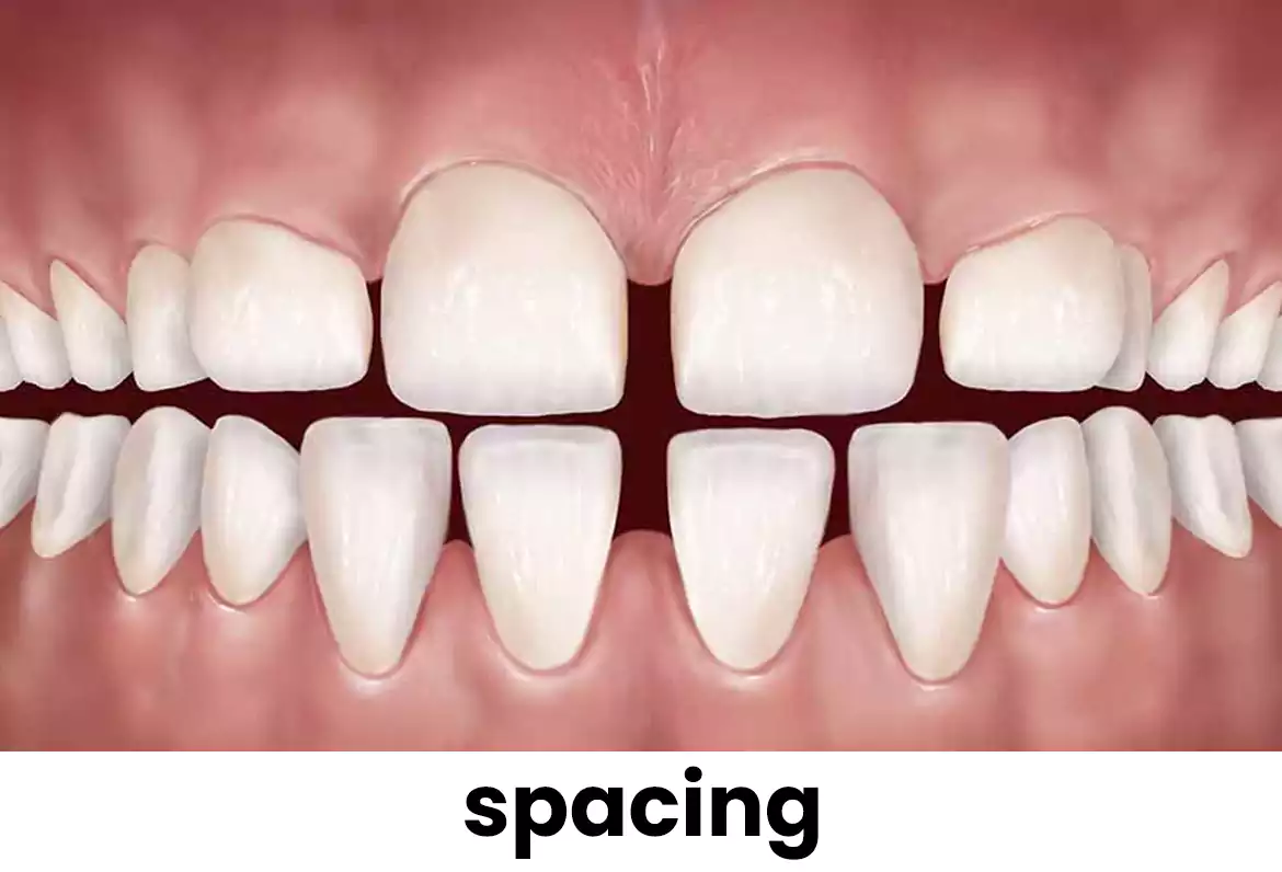 فراغات الأسنان Spacing