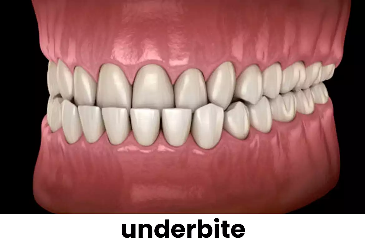 Underbite